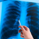 Закарпаття займає 4 місце за виявленими випадками туберкульозу