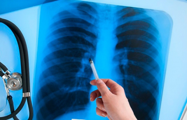Закарпаття займає 4 місце за виявленими випадками туберкульозу
